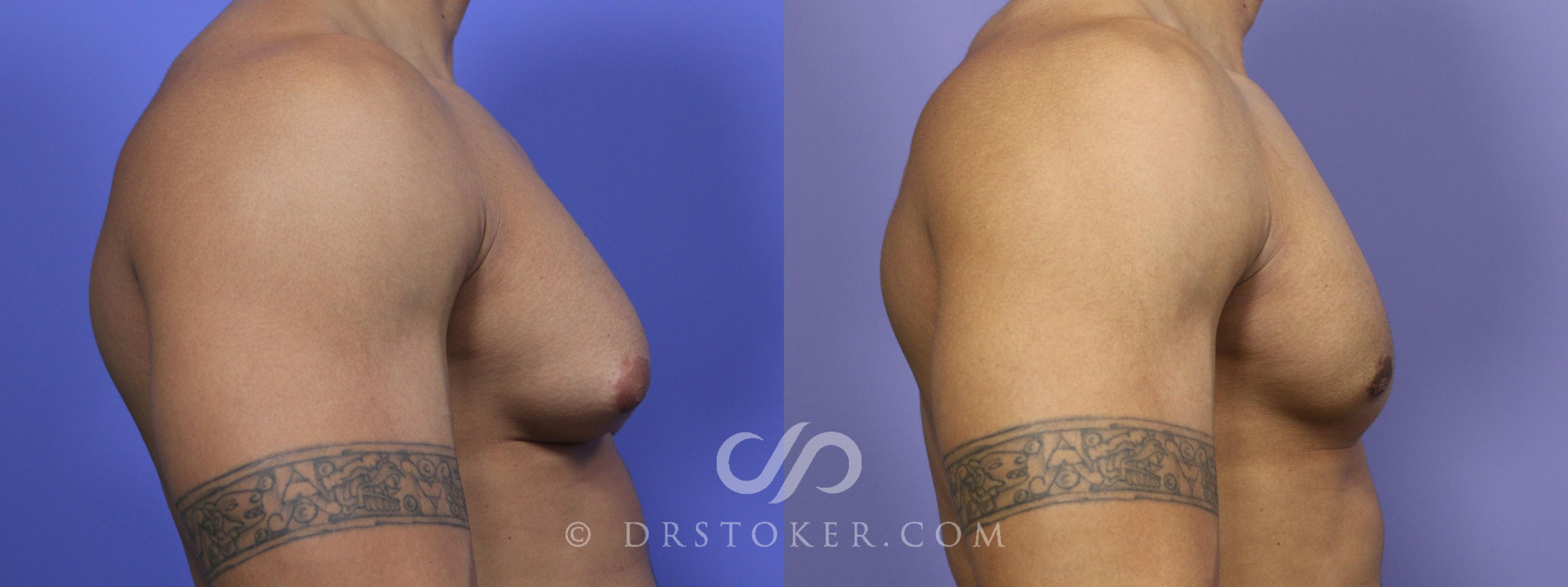 Before & After Breast Reduction for Men (Gynecomastia) Case 2231 Right Side View in Los Angeles, CA