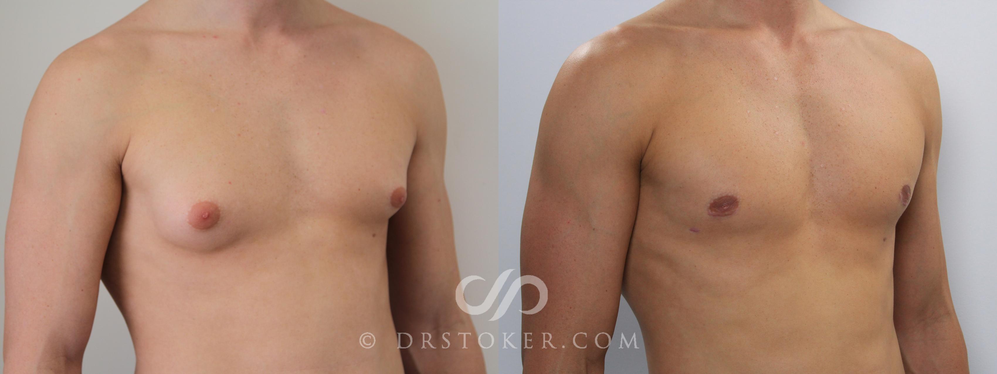 Before & After Breast Reduction for Men (Gynecomastia) Case 2232 Right Oblique View in Los Angeles, CA