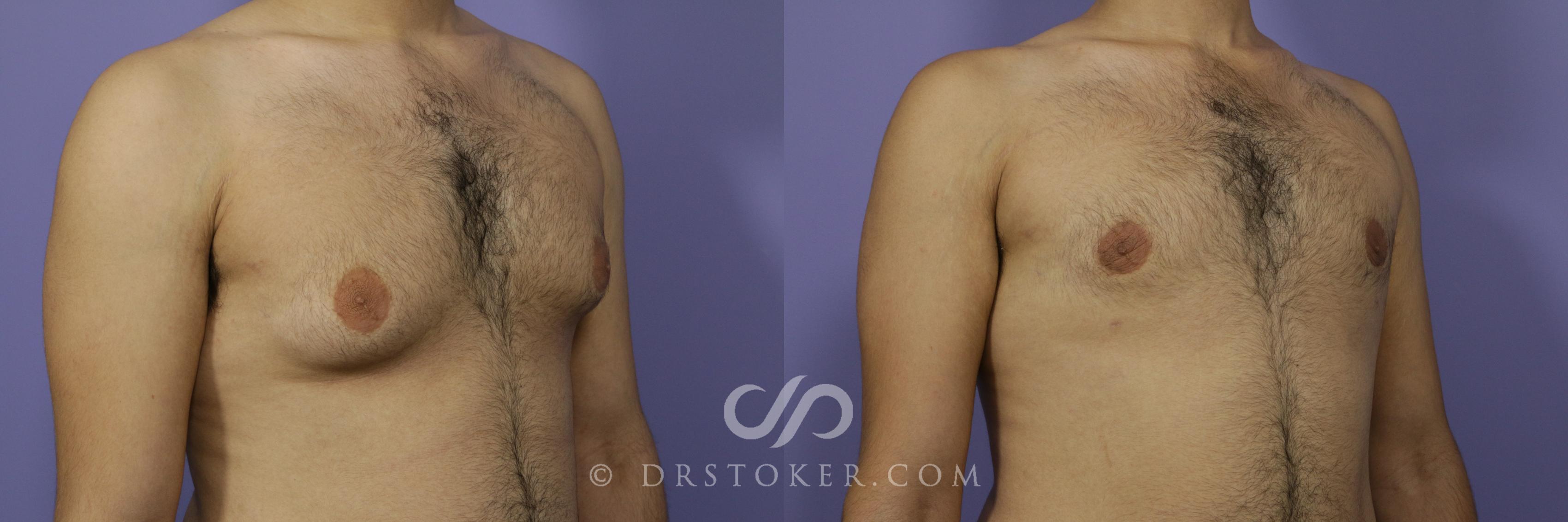 Before & After Breast Reduction for Men (Gynecomastia) Case 2235 Right Oblique View in Los Angeles, CA