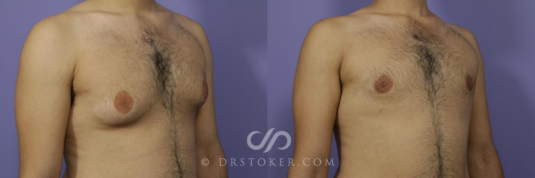 Before & After Breast Reduction for Men (Gynecomastia) Case 2235 Right Oblique View in Los Angeles, CA