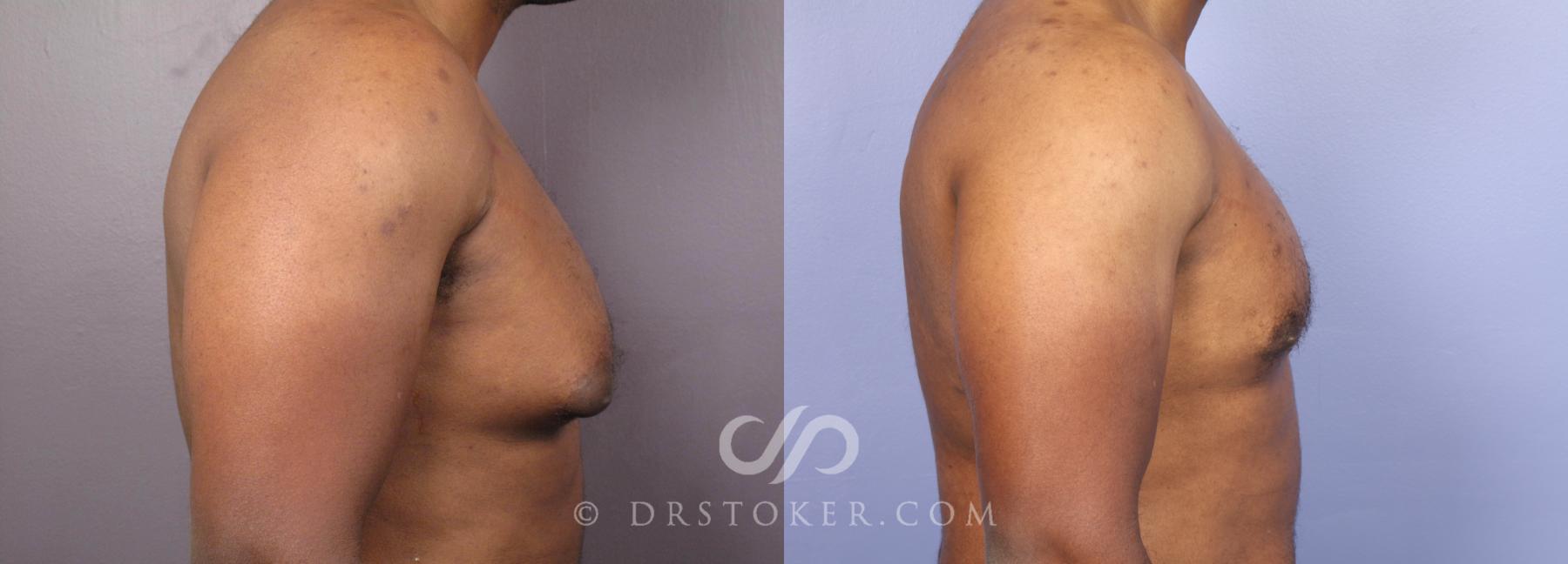 Before & After Breast Reduction for Men (Gynecomastia) Case 2239 Right Side View in Los Angeles, CA