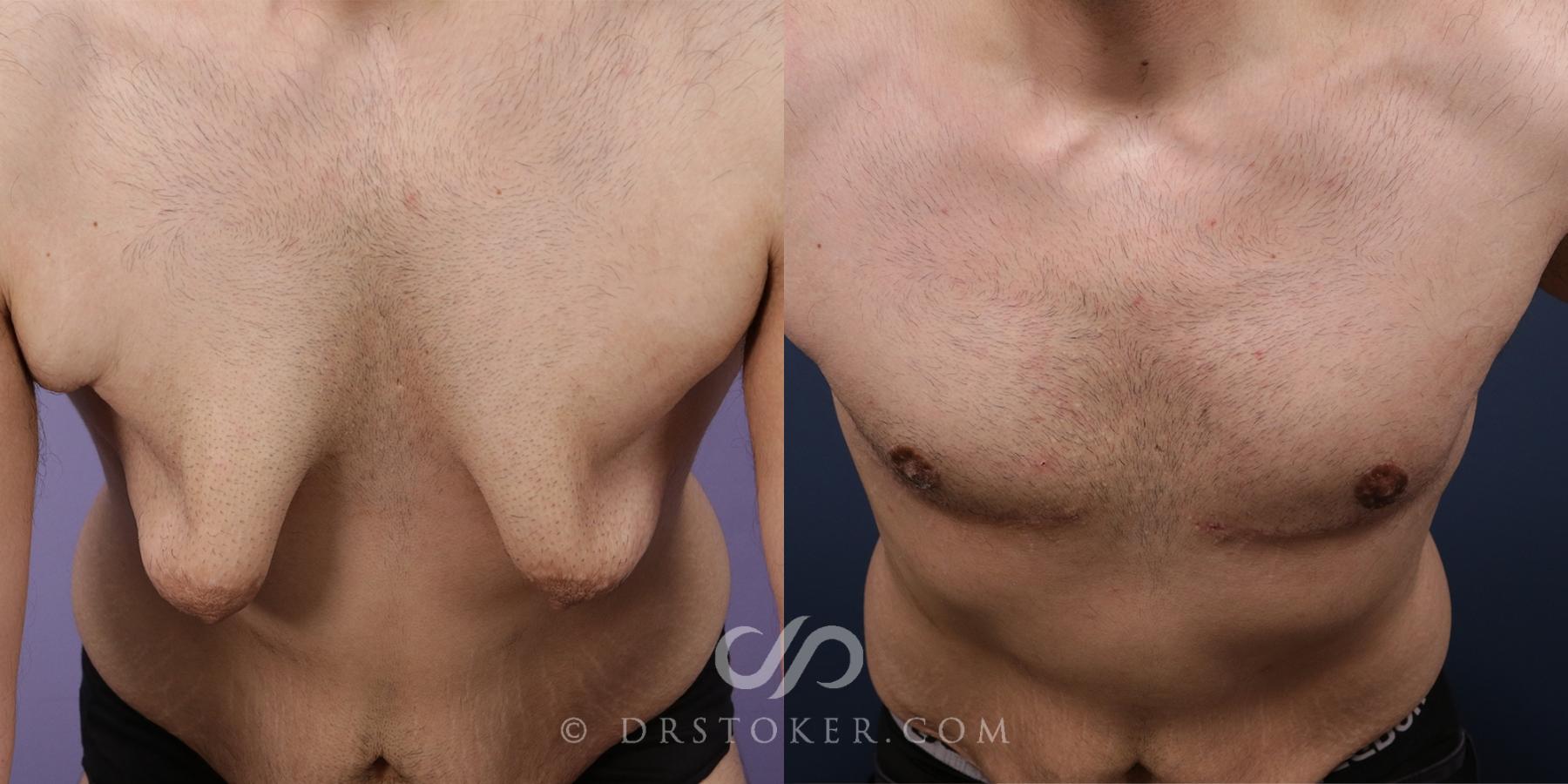 Before & After Breast Reduction for Men (Gynecomastia) Case 2258 Front View in Los Angeles, CA