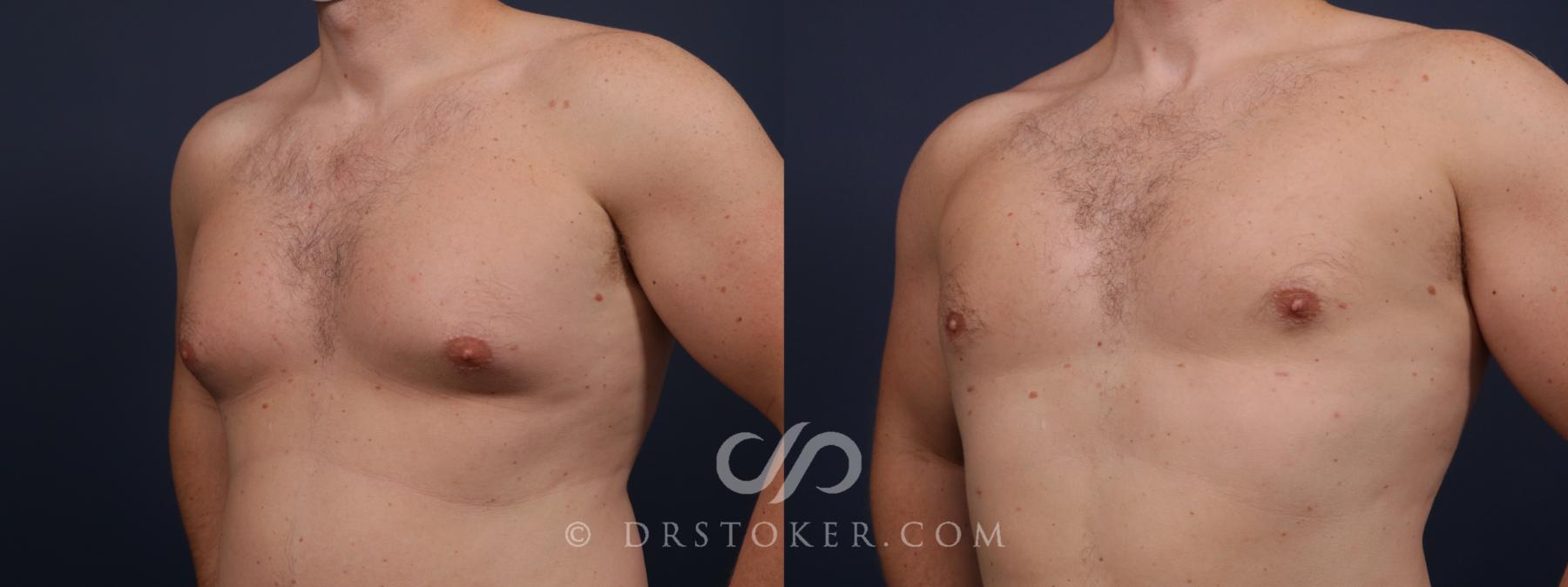 Before & After Breast Reduction for Men (Gynecomastia) Case 2647 Left Oblique View in Los Angeles, CA