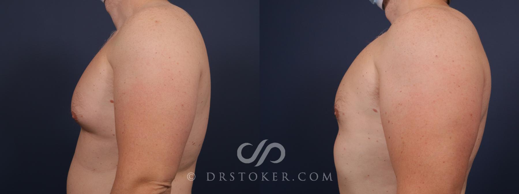 Before & After Breast Reduction for Men (Gynecomastia) Case 2647 Left Side View in Los Angeles, CA