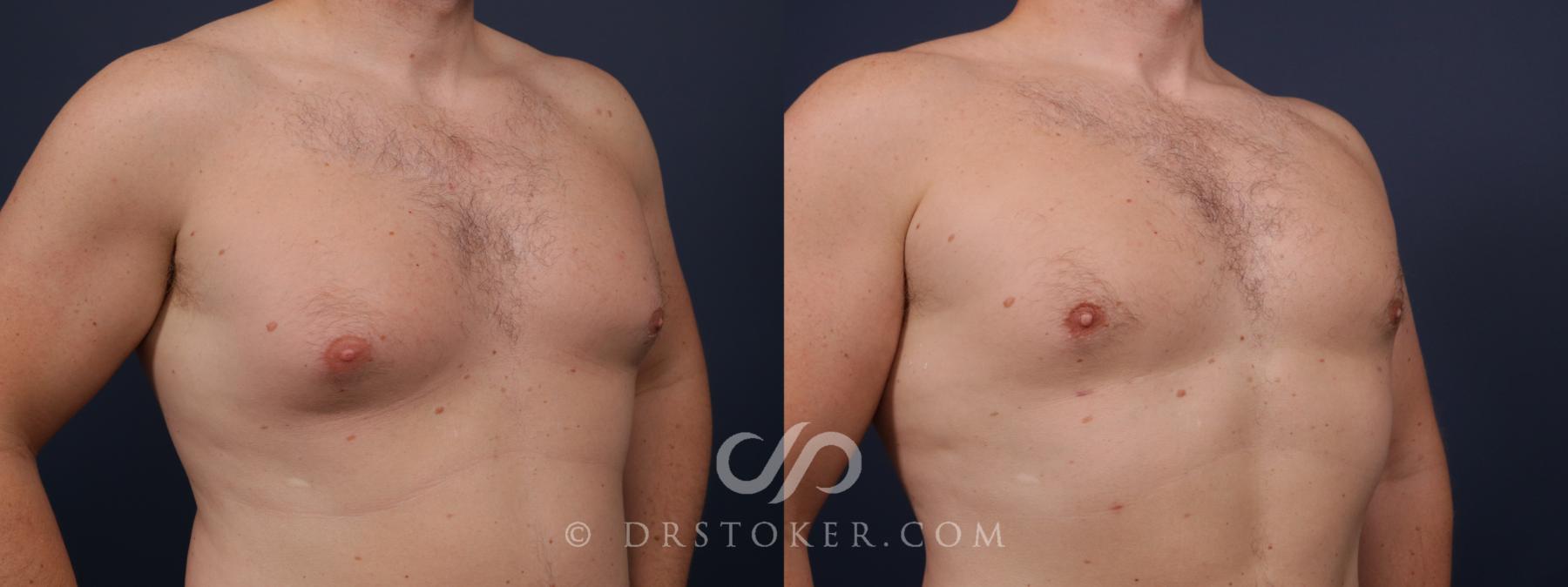 Before & After Breast Reduction for Men (Gynecomastia) Case 2647 Right Oblique View in Los Angeles, CA