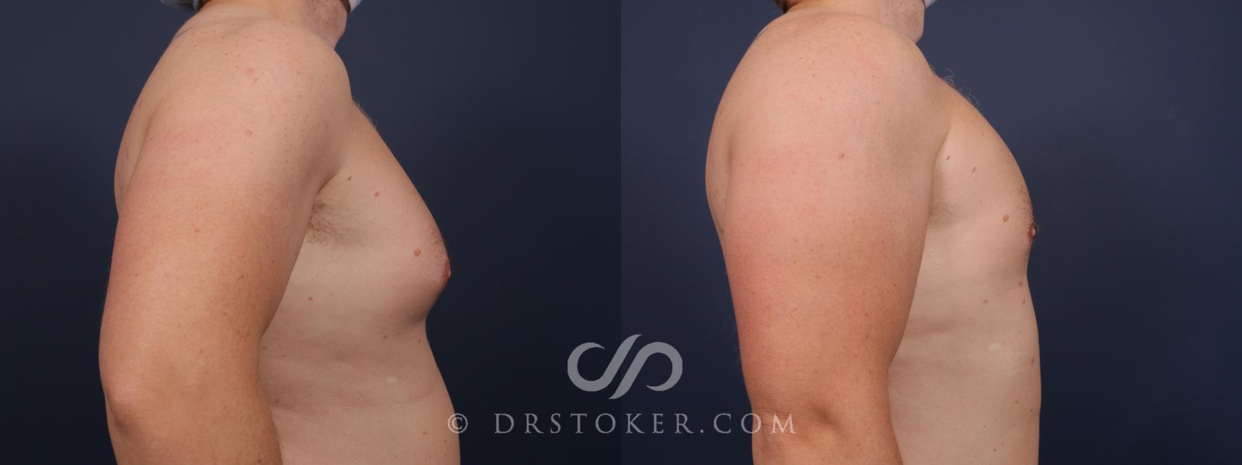 Before & After Breast Reduction for Men (Gynecomastia) Case 2647 Right Side View in Los Angeles, CA