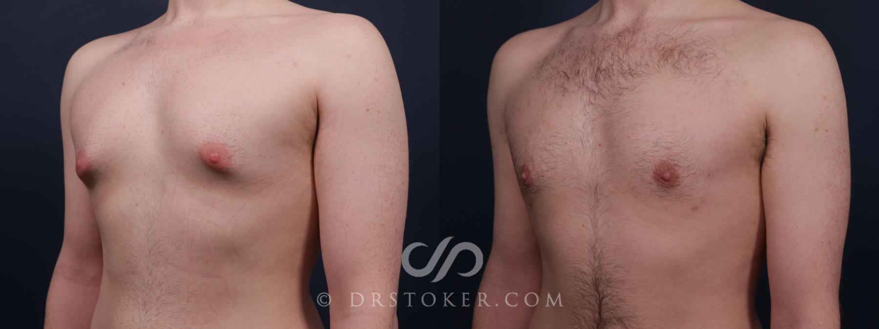 Before & After Breast Reduction for Men (Gynecomastia) Case 2648 Left Oblique View in Los Angeles, CA