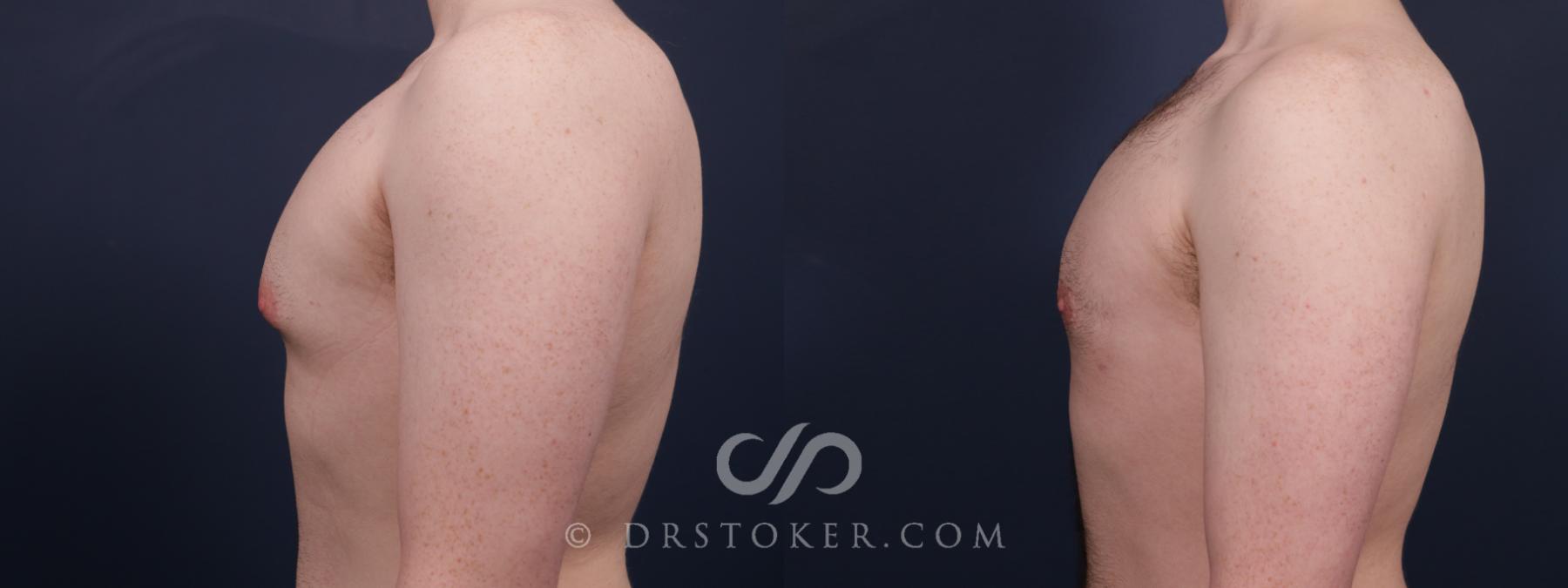 Before & After Breast Reduction for Men (Gynecomastia) Case 2648 Left Side View in Los Angeles, CA