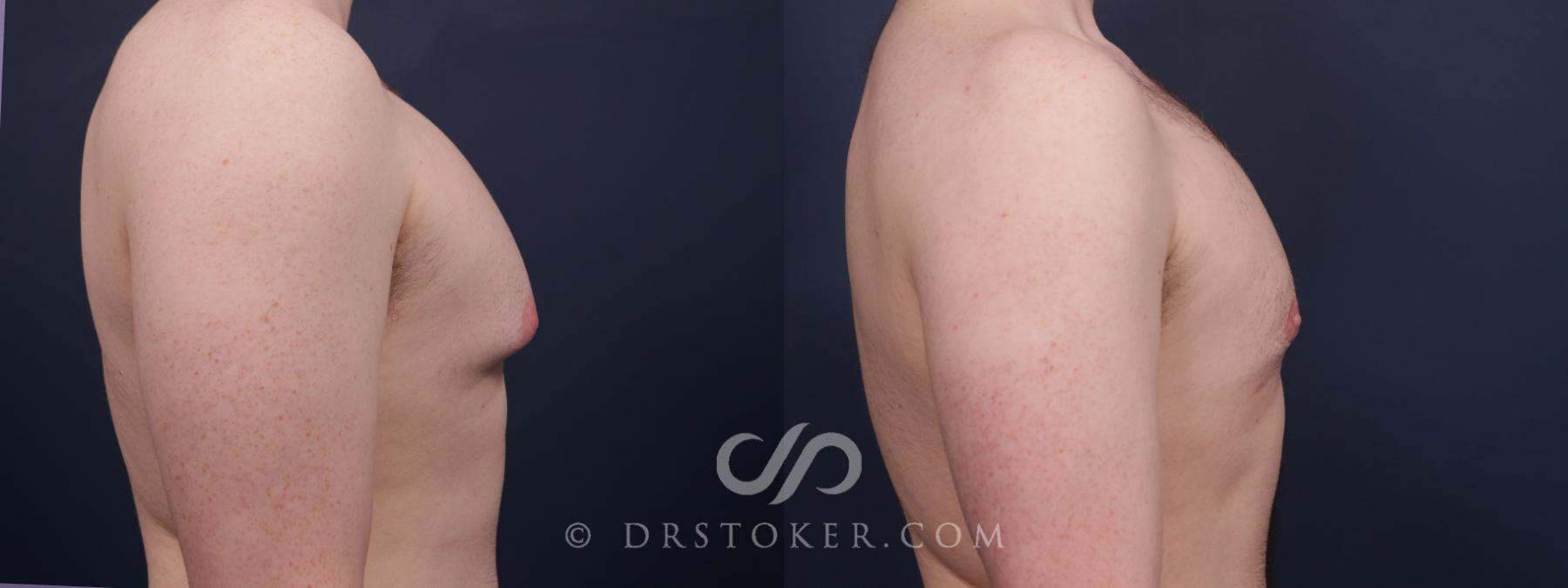 Before & After Breast Reduction for Men (Gynecomastia) Case 2648 Right Side View in Los Angeles, CA