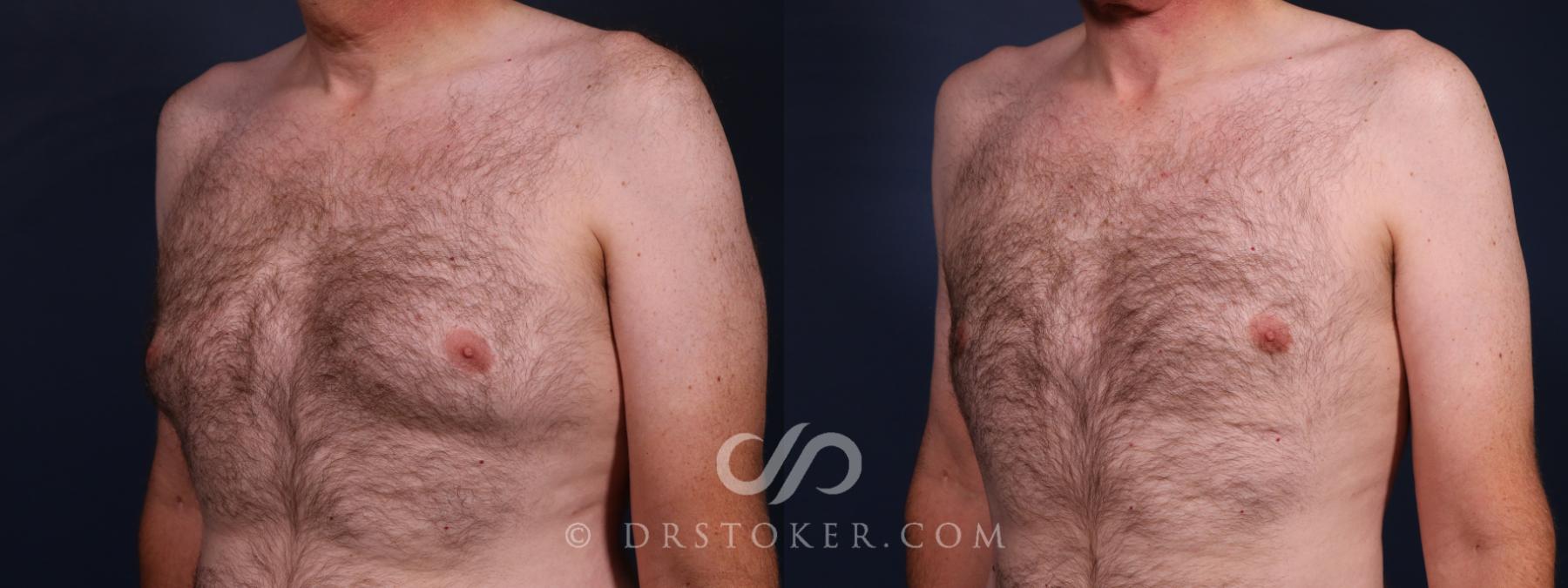 Before & After Breast Reduction for Men (Gynecomastia) Case 2668 Left Oblique View in Los Angeles, CA
