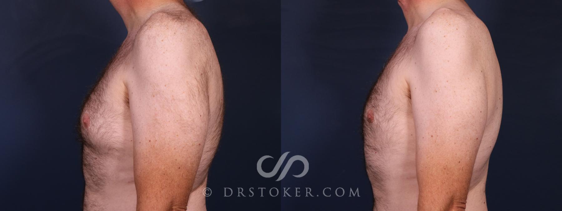 Before & After Breast Reduction for Men (Gynecomastia) Case 2668 Left Side View in Los Angeles, CA