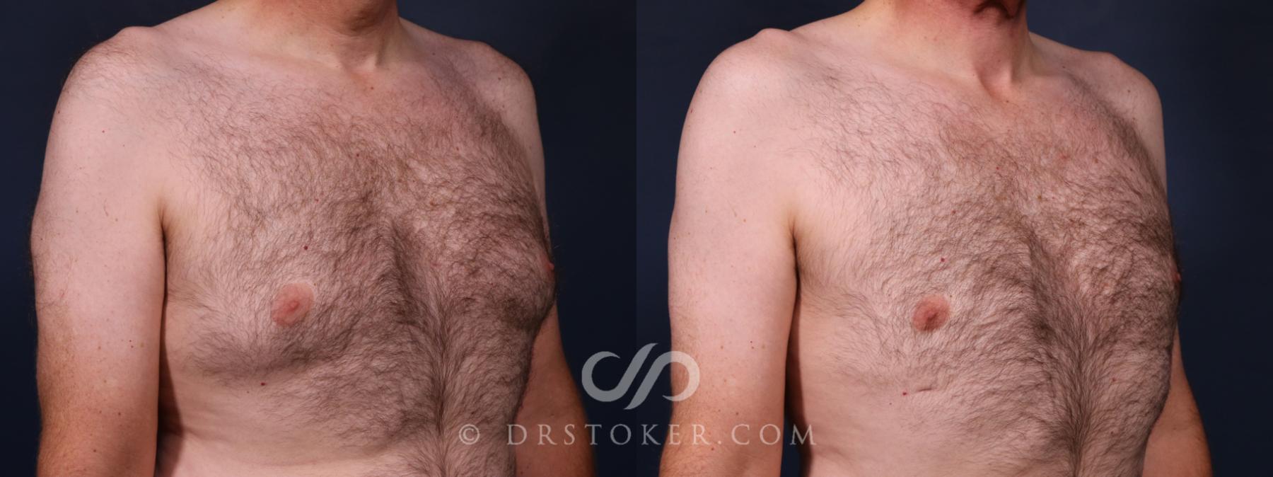 Before & After Breast Reduction for Men (Gynecomastia) Case 2668 Right Oblique View in Los Angeles, CA