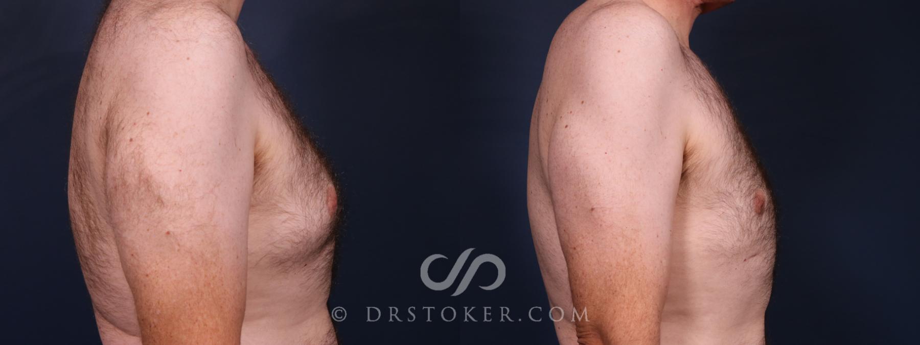 Before & After Breast Reduction for Men (Gynecomastia) Case 2668 Right Side View in Los Angeles, CA
