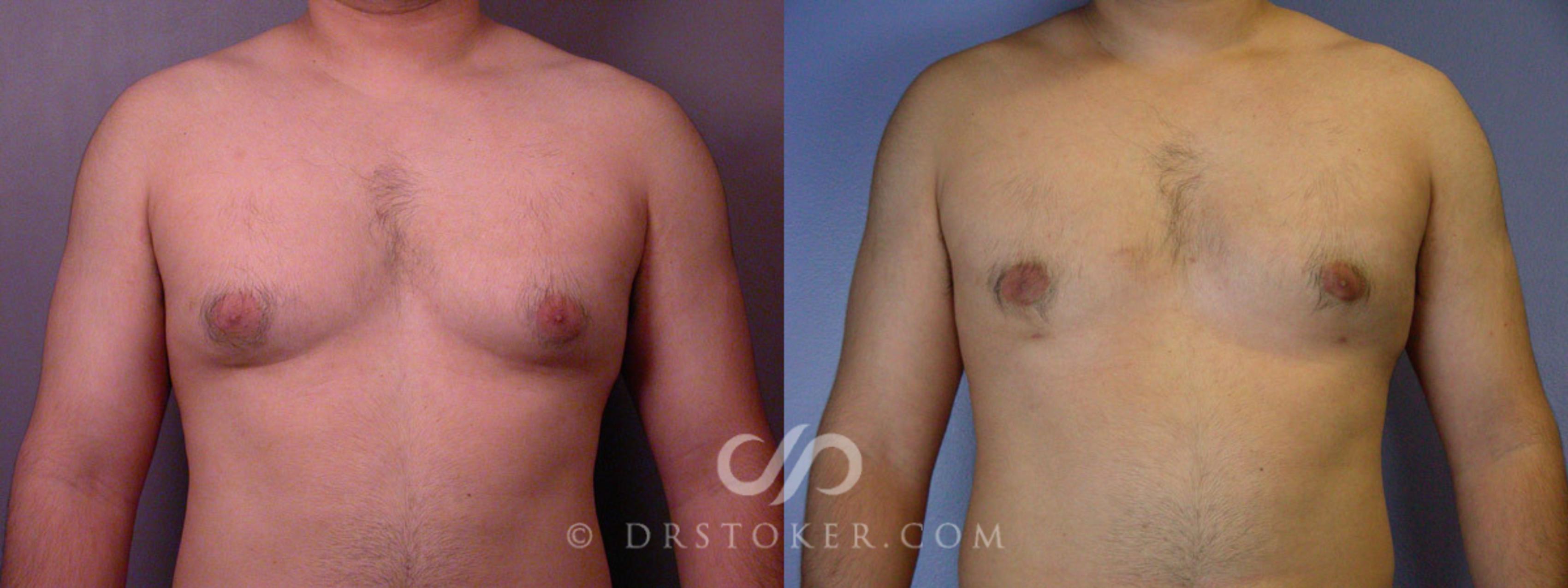 Before & After Breast Reduction for Men (Gynecomastia) Case 285 View #1 View in Los Angeles, CA