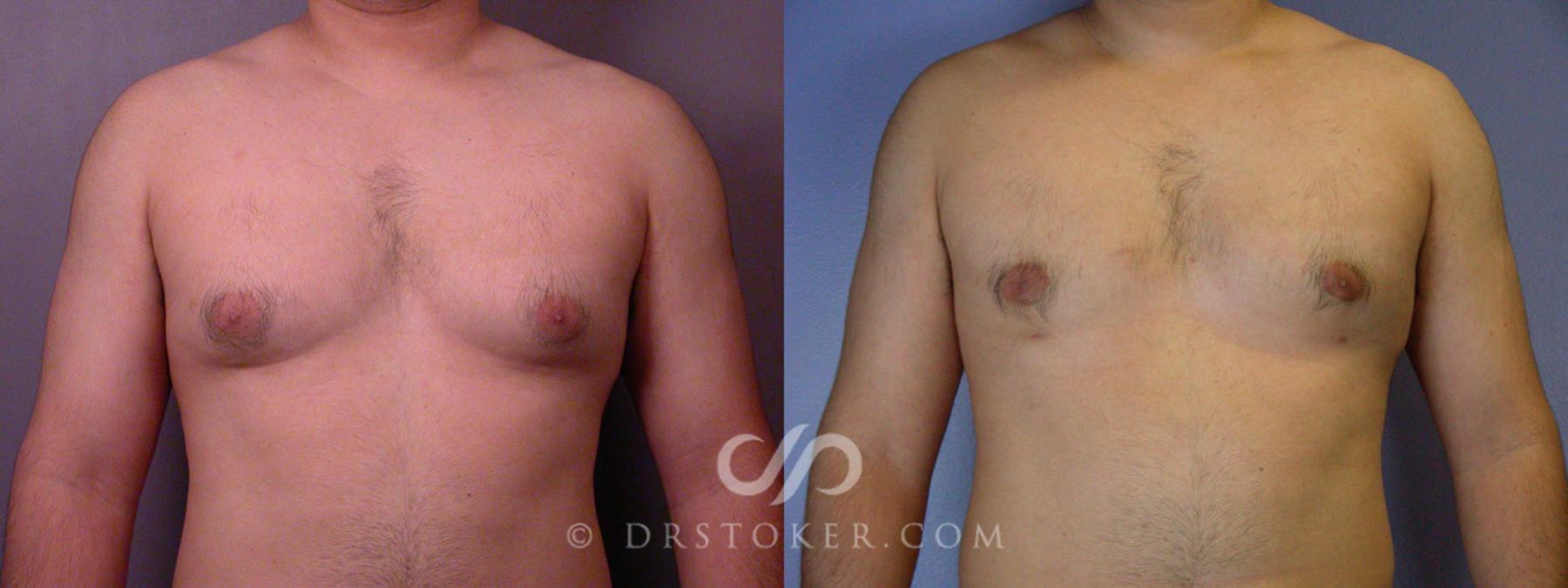 Before & After Breast Reduction for Men (Gynecomastia) Case 285 View #1 View in Los Angeles, CA