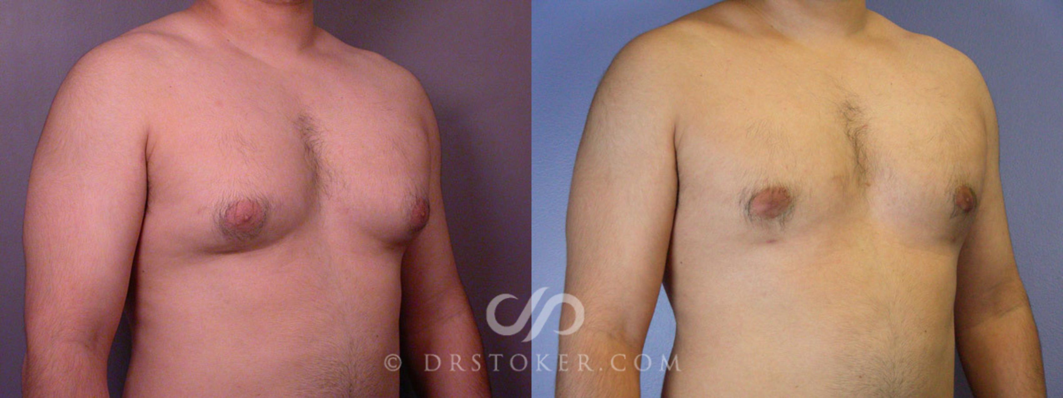 Before & After Breast Reduction for Men (Gynecomastia) Case 285 View #2 View in Los Angeles, CA