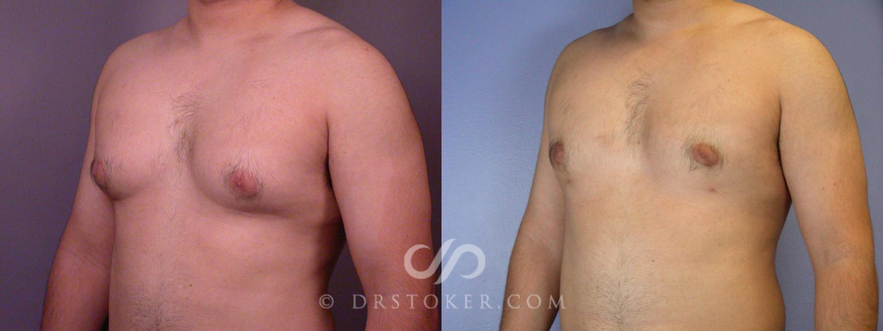 Before & After Breast Reduction for Men (Gynecomastia) Case 285 View #3 View in Los Angeles, CA