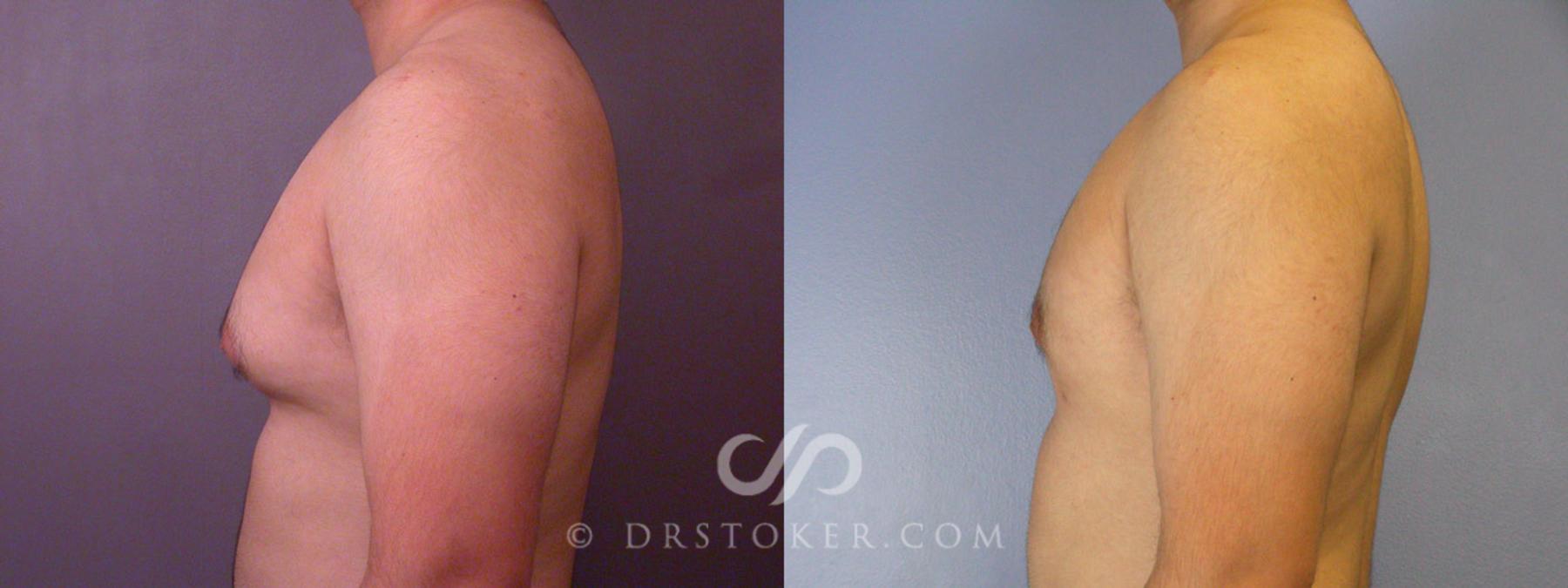 Before & After Breast Reduction for Men (Gynecomastia) Case 285 View #4 View in Los Angeles, CA