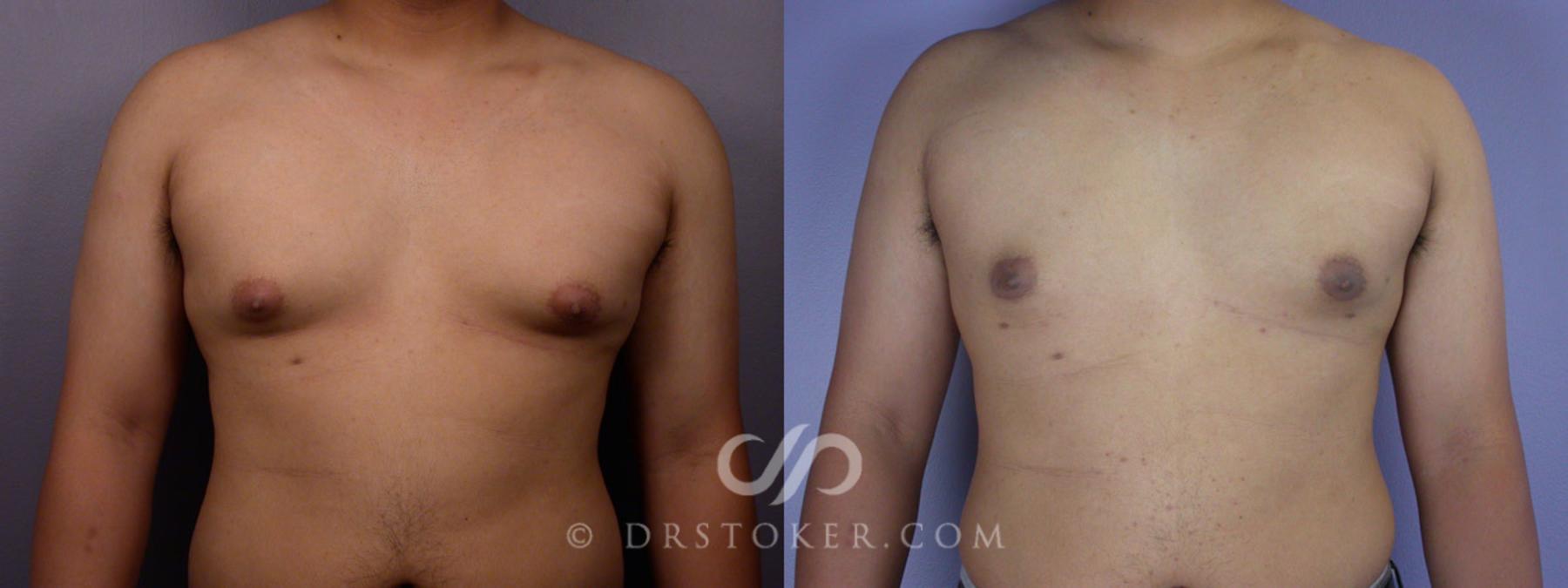 Before & After Breast Reduction for Men (Gynecomastia) Case 286 View #1 View in Los Angeles, CA