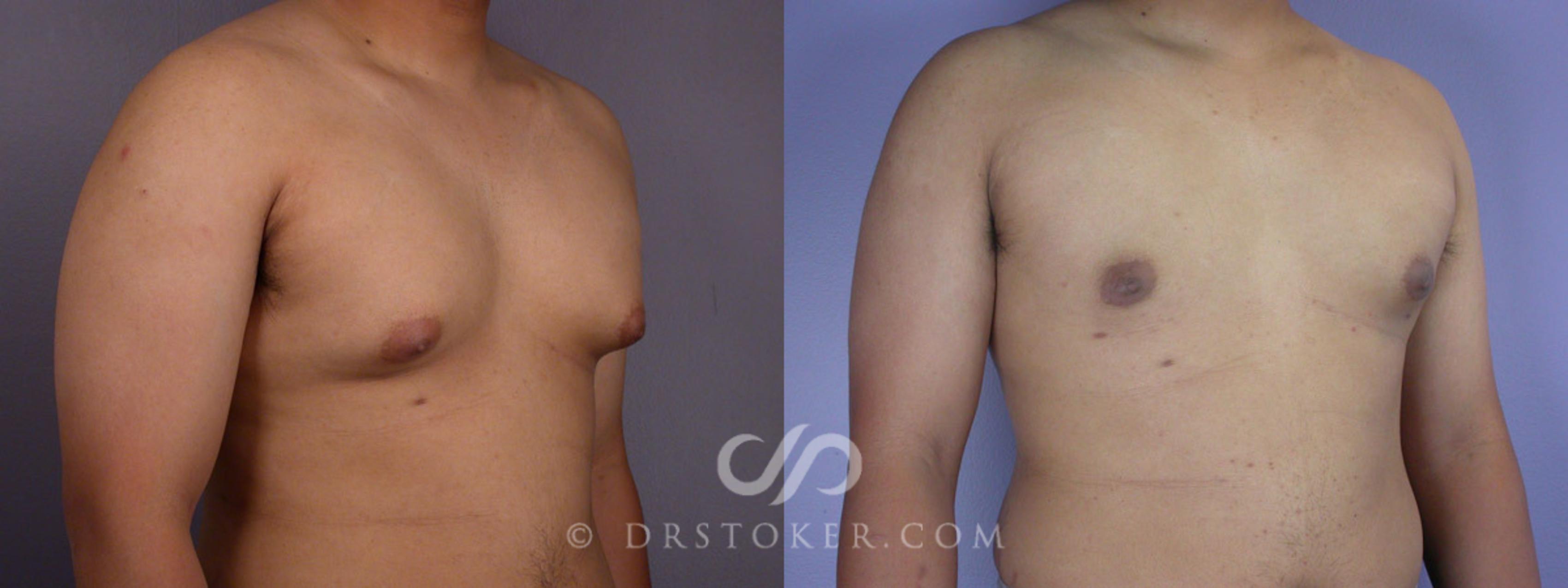 Before & After Breast Reduction for Men (Gynecomastia) Case 286 View #2 View in Los Angeles, CA