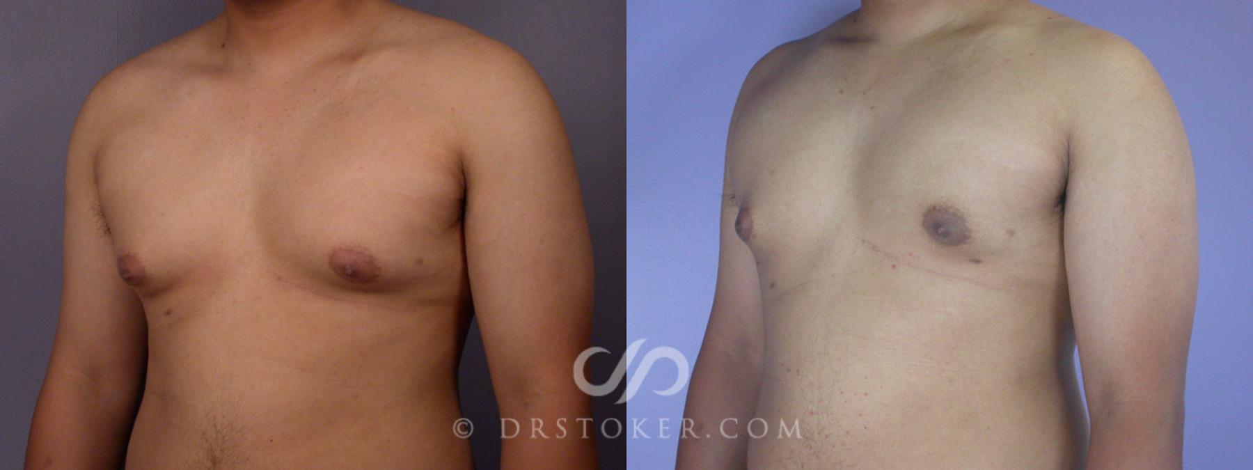 Before & After Breast Reduction for Men (Gynecomastia) Case 286 View #3 View in Los Angeles, CA