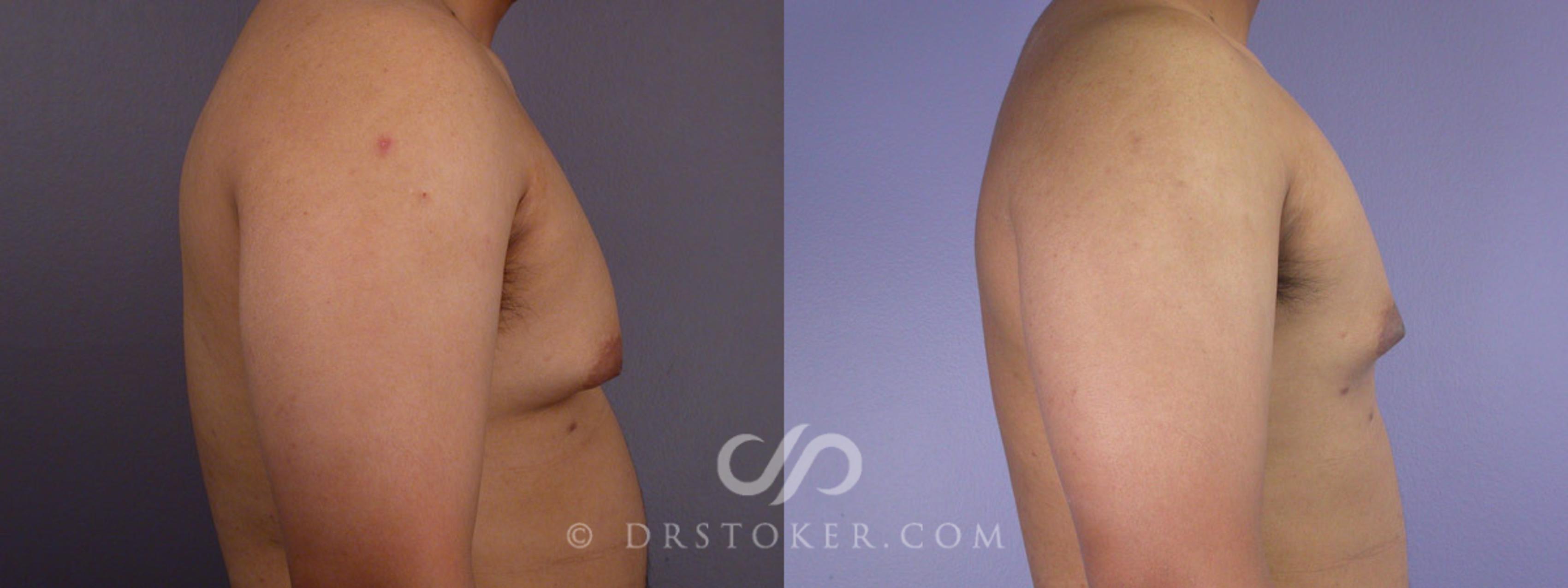 Before & After Breast Reduction for Men (Gynecomastia) Case 286 View #4 View in Los Angeles, CA