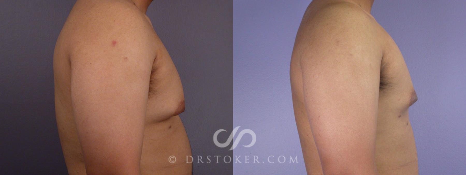 Before & After Breast Reduction for Men (Gynecomastia) Case 286 View #4 View in Los Angeles, CA