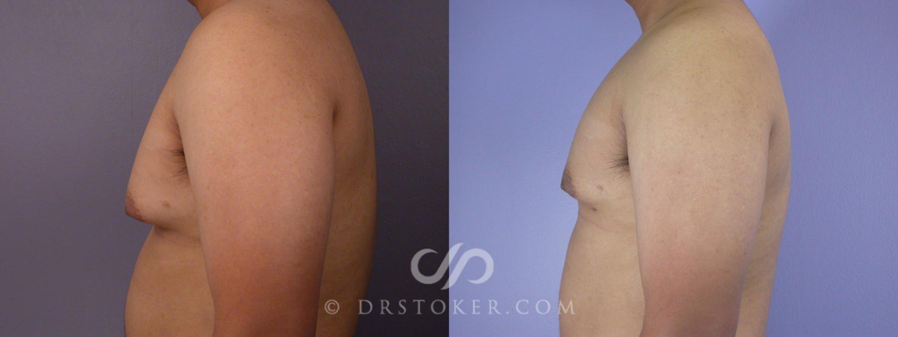 Before & After Breast Reduction for Men (Gynecomastia) Case 286 View #5 View in Los Angeles, CA