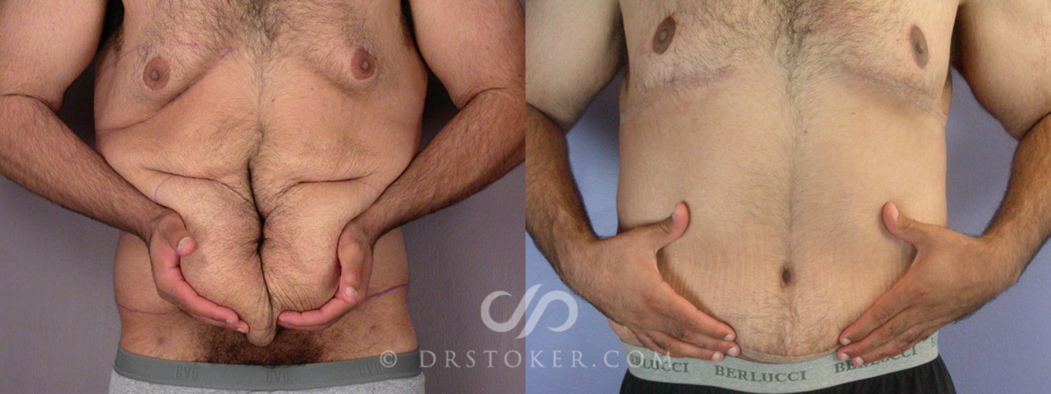 Before & After Breast Reduction for Men (Gynecomastia) Case 295 View #2 View in Los Angeles, CA