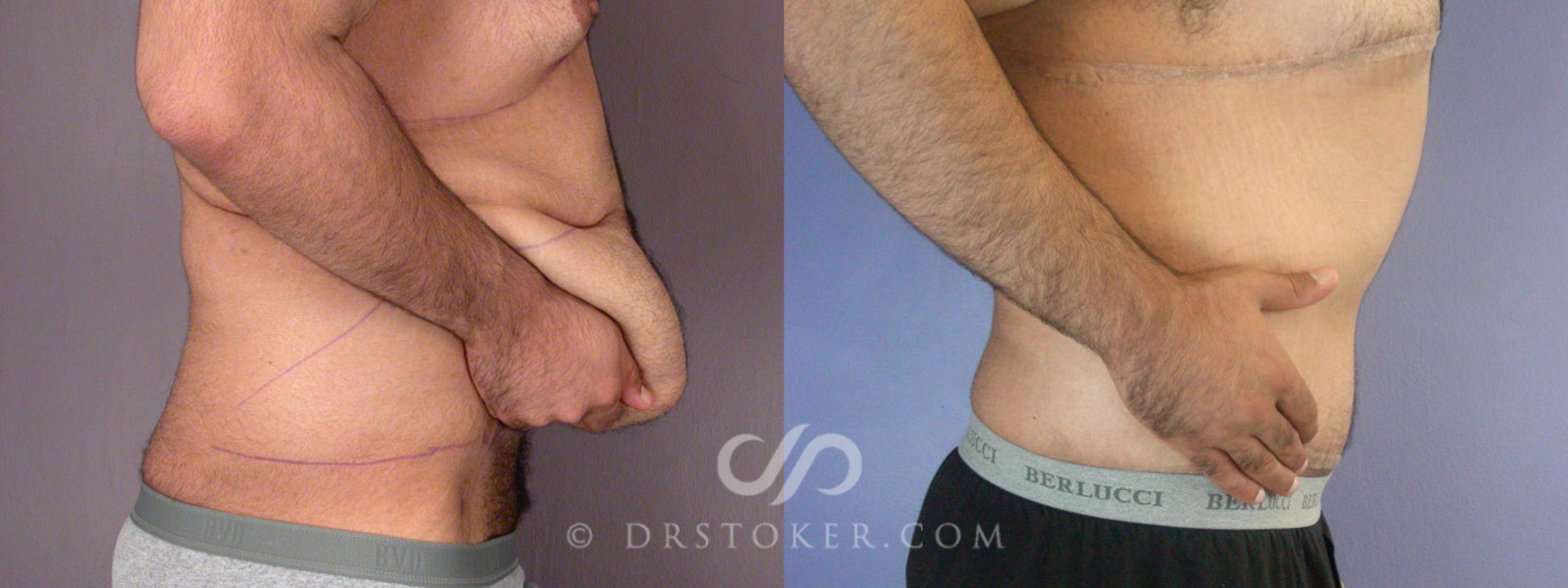 Before & After Breast Reduction for Men (Gynecomastia) Case 295 View #3 View in Los Angeles, CA