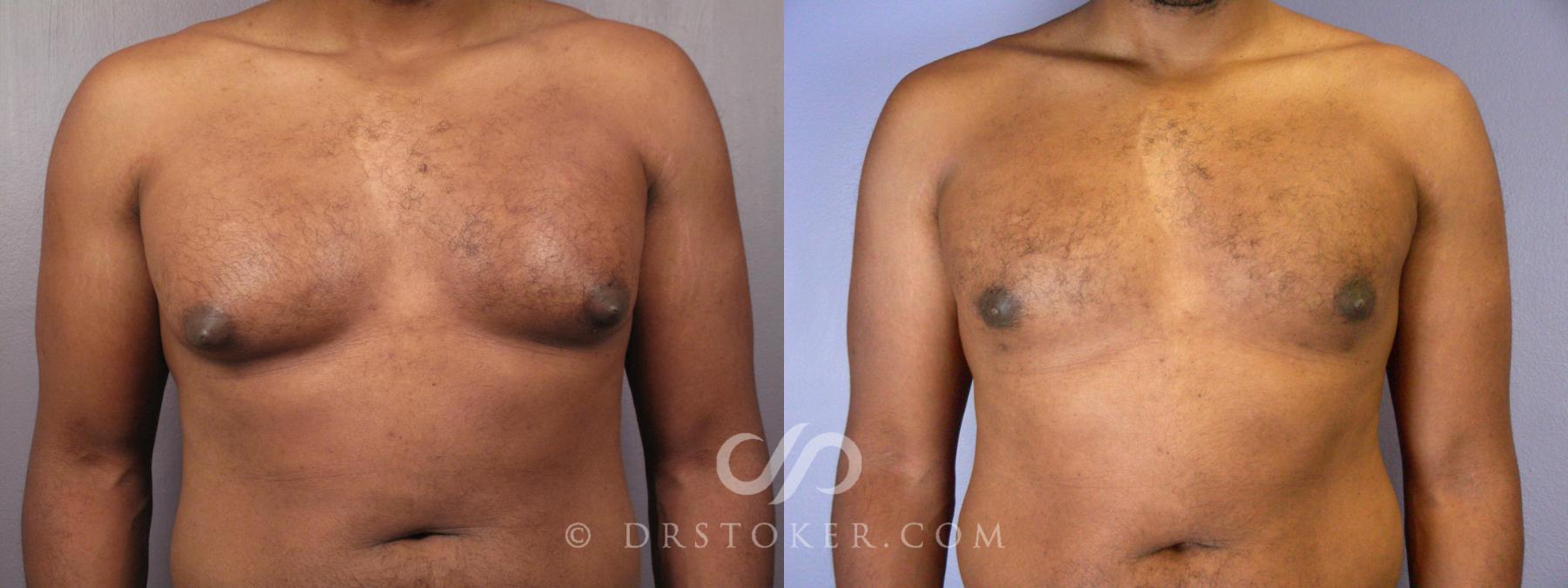 Before & After Breast Reduction for Men (Gynecomastia) Case 379 View #1 View in Los Angeles, CA