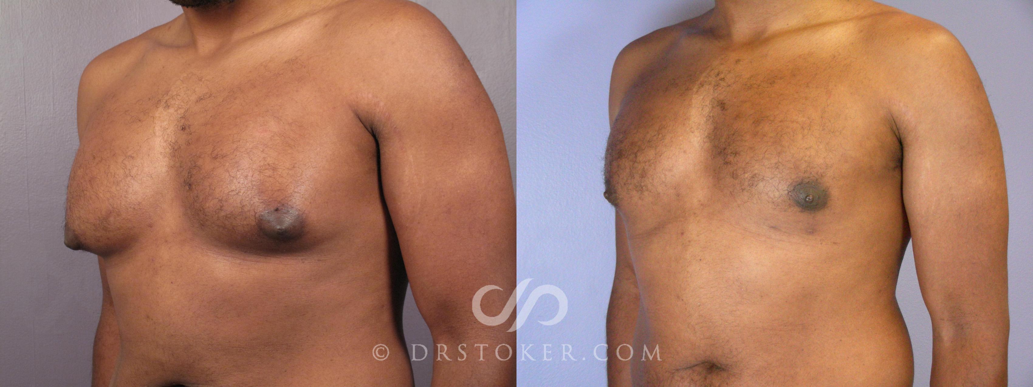 Before & After Breast Reduction for Men (Gynecomastia) Case 379 View #2 View in Los Angeles, CA