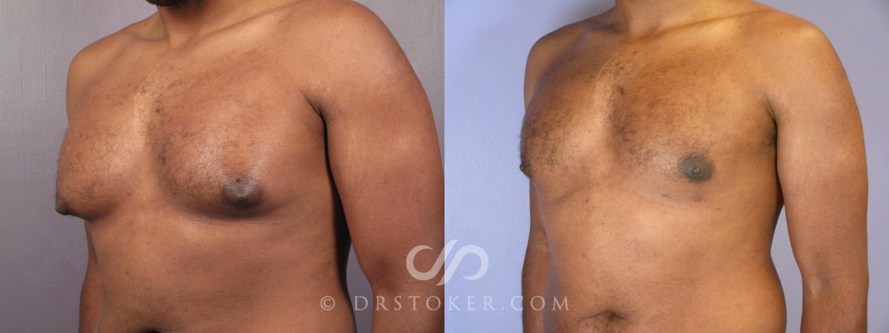 Before & After Breast Reduction for Men (Gynecomastia) Case 379 View #2 View in Los Angeles, CA