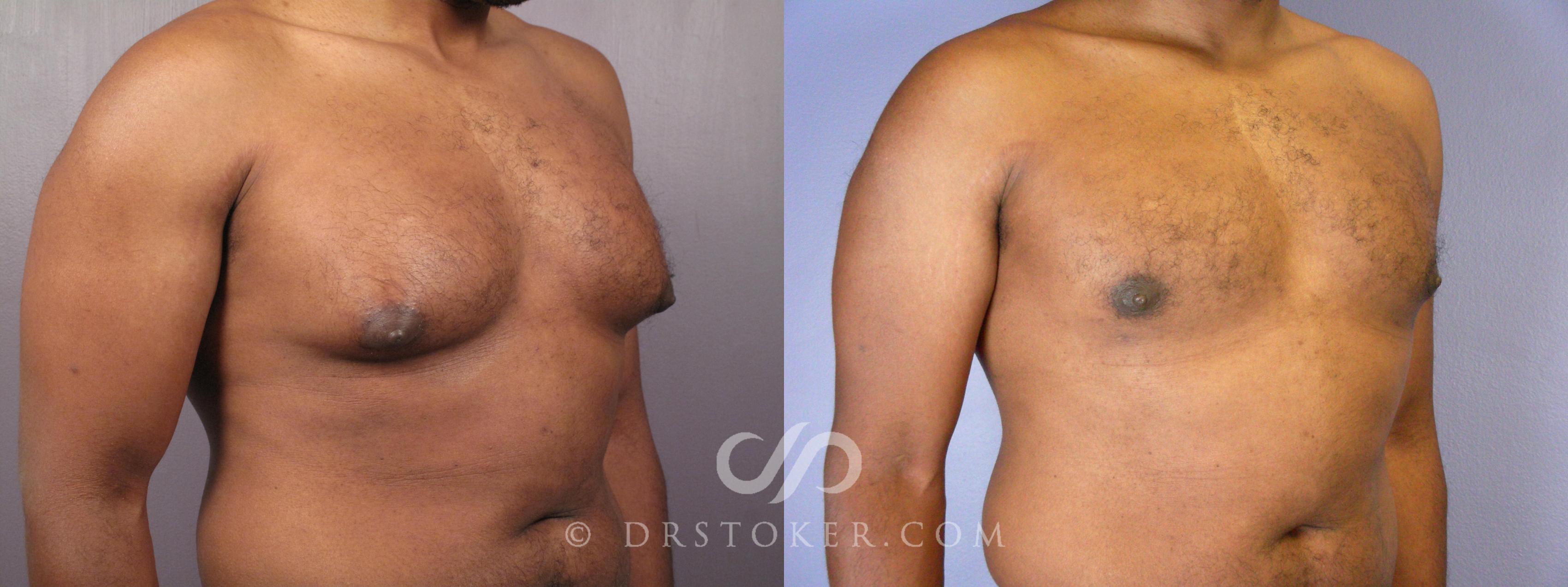 Before & After Breast Reduction for Men (Gynecomastia) Case 379 View #3 View in Los Angeles, CA