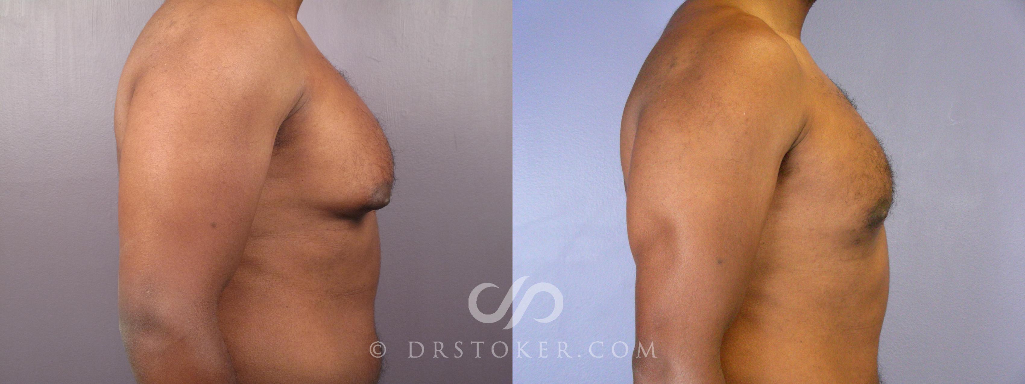 Before & After Breast Reduction for Men (Gynecomastia) Case 379 View #4 View in Los Angeles, CA