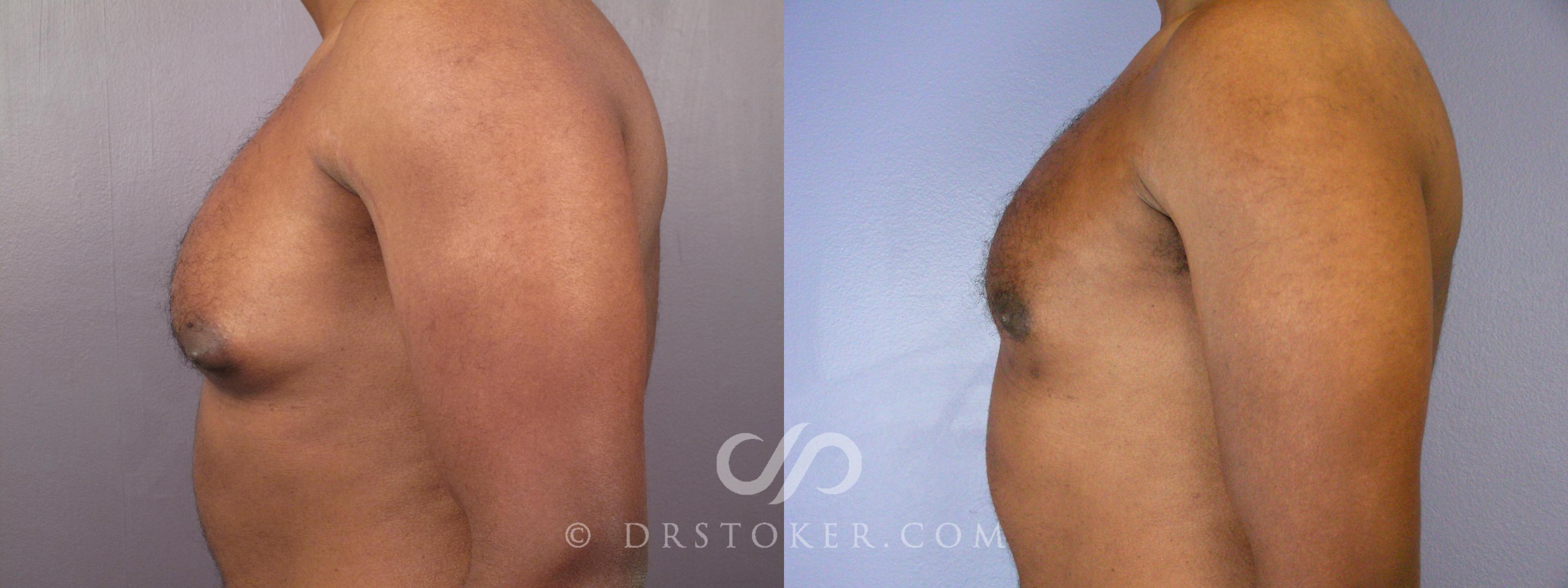 Before & After Breast Reduction for Men (Gynecomastia) Case 379 View #5 View in Los Angeles, CA