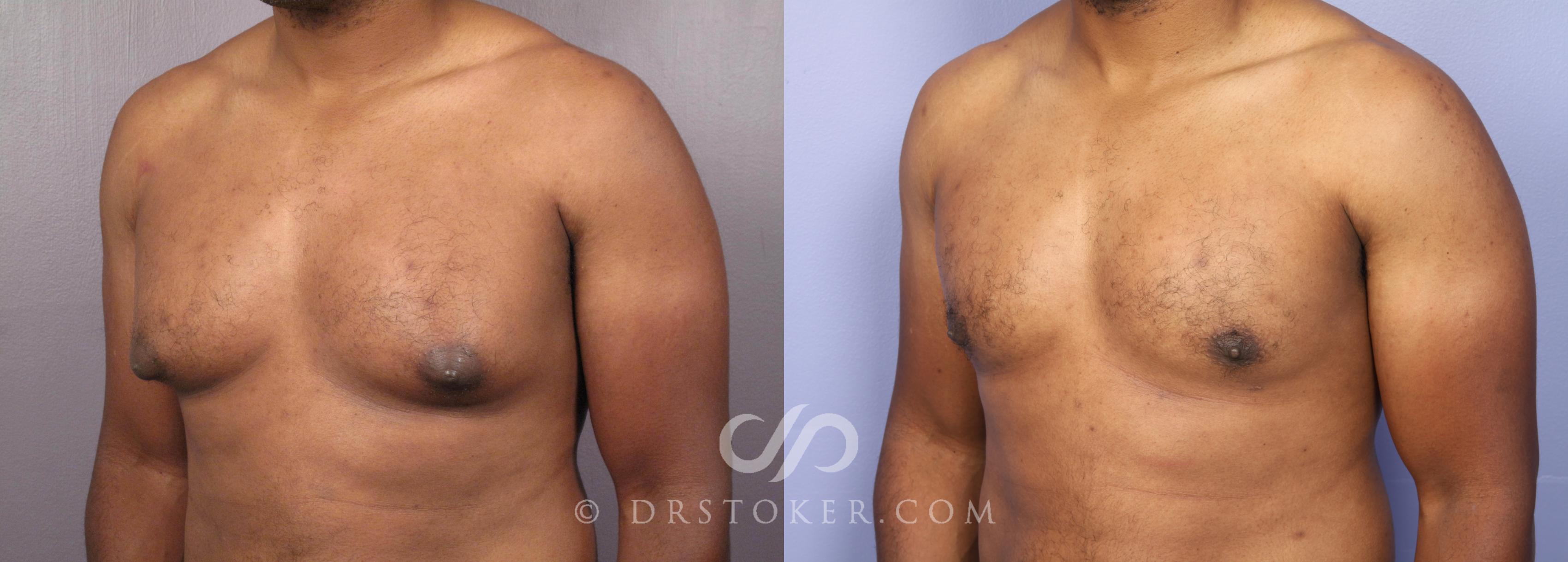 Before & After Breast Reduction for Men (Gynecomastia) Case 475 View #3 View in Los Angeles, CA