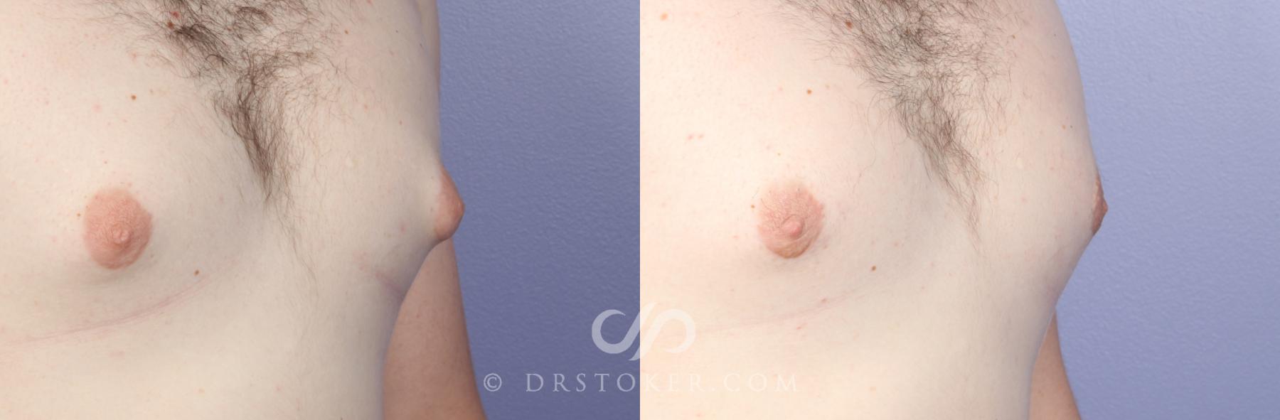 Before & After Breast Reduction for Men (Gynecomastia) Case 491 View #2 View in Los Angeles, CA