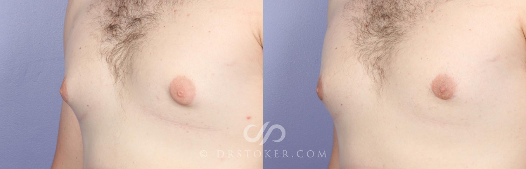 Before & After Breast Reduction for Men (Gynecomastia) Case 491 View #3 View in Los Angeles, CA