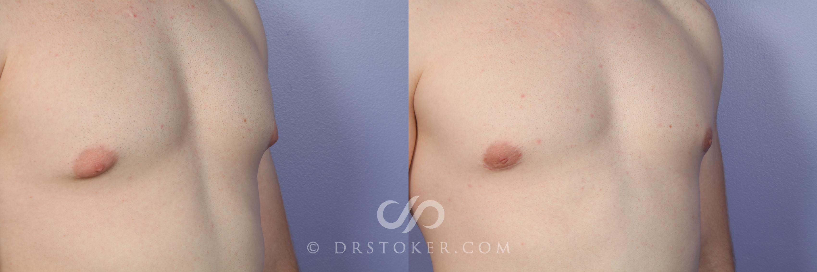 Before & After Breast Reduction for Men (Gynecomastia) Case 510 View #2 View in Los Angeles, CA