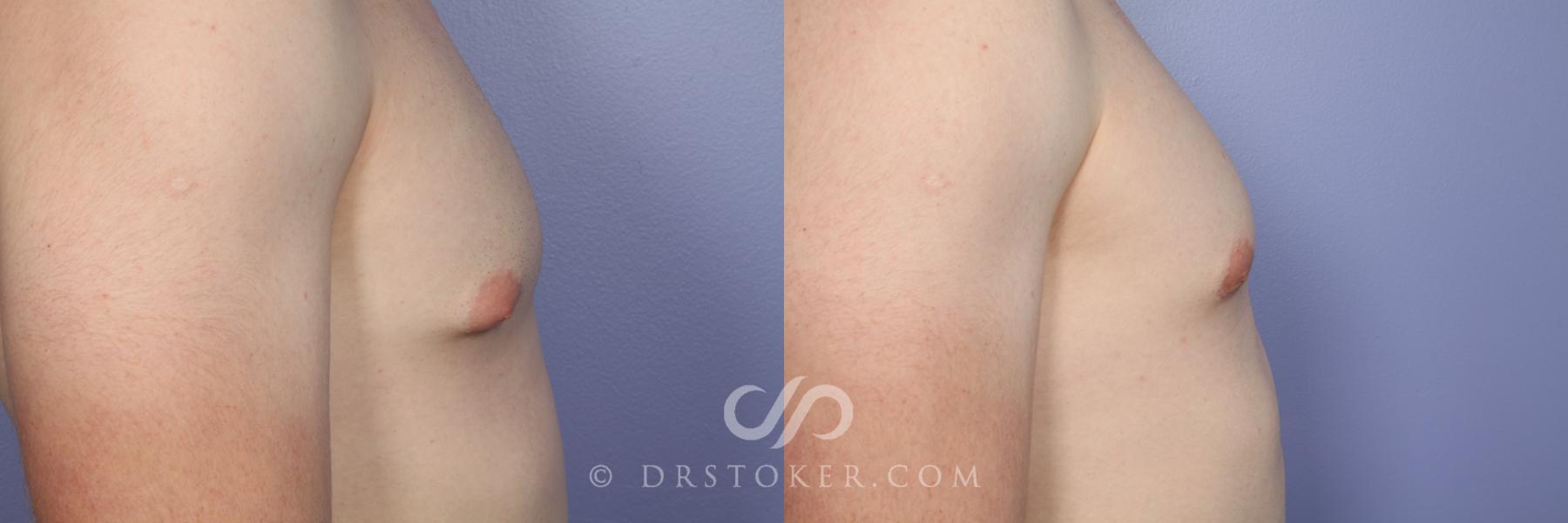 Before & After Breast Reduction for Men (Gynecomastia) Case 510 View #3 View in Los Angeles, CA