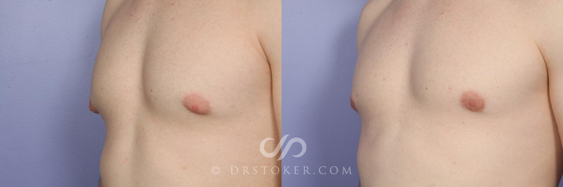 Before & After Breast Reduction for Men (Gynecomastia) Case 510 View #4 View in Los Angeles, CA