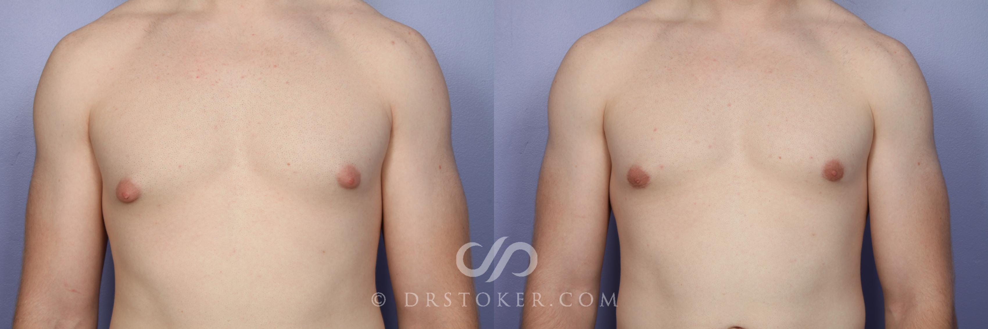 Before & After Breast Reduction for Men (Gynecomastia) Case 510 View #5 View in Los Angeles, CA