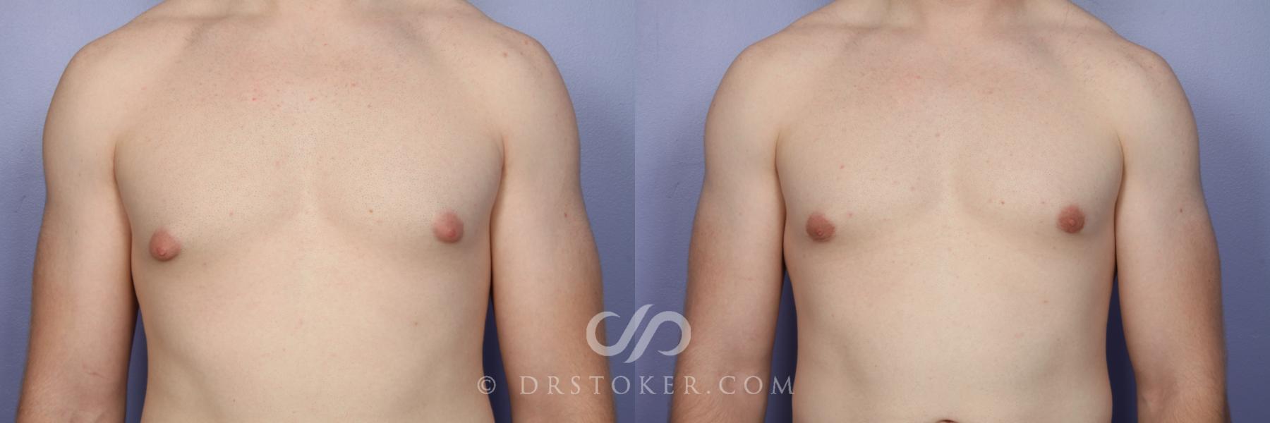 Before & After Breast Reduction for Men (Gynecomastia) Case 510 View #5 View in Los Angeles, CA