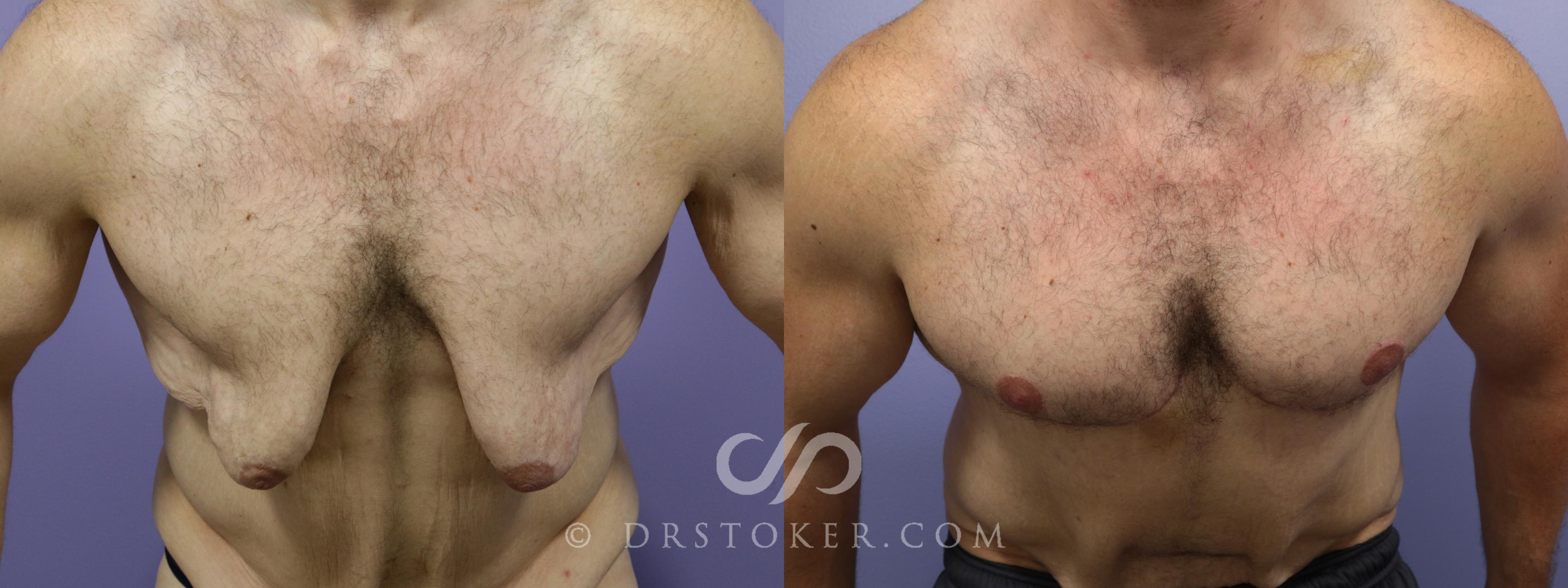 Before & After Breast Reduction for Men (Gynecomastia) Case 775 View #1 View in Los Angeles, CA