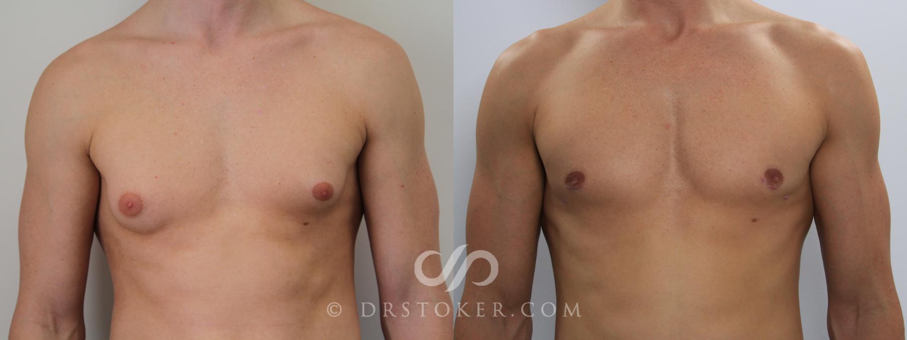 Before & After Breast Reduction for Men (Gynecomastia) Case 783 View #1 View in Los Angeles, CA