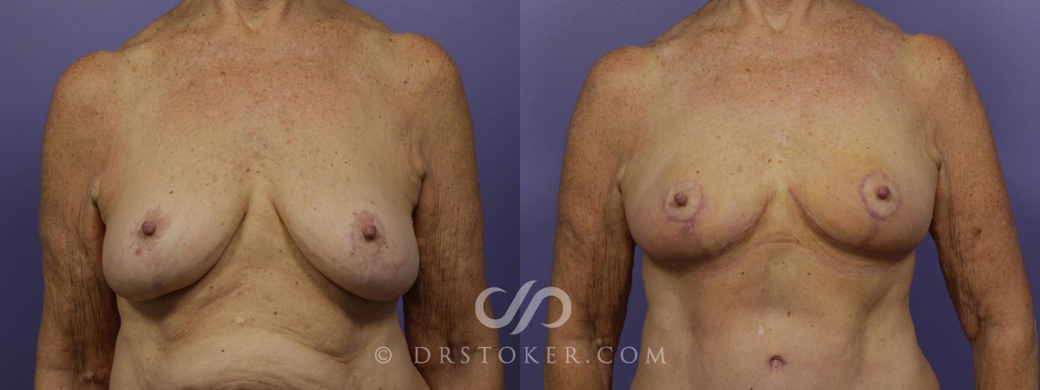 Before & After Breast Reduction (for Women) Case 1290 View #1 View in Los Angeles, CA