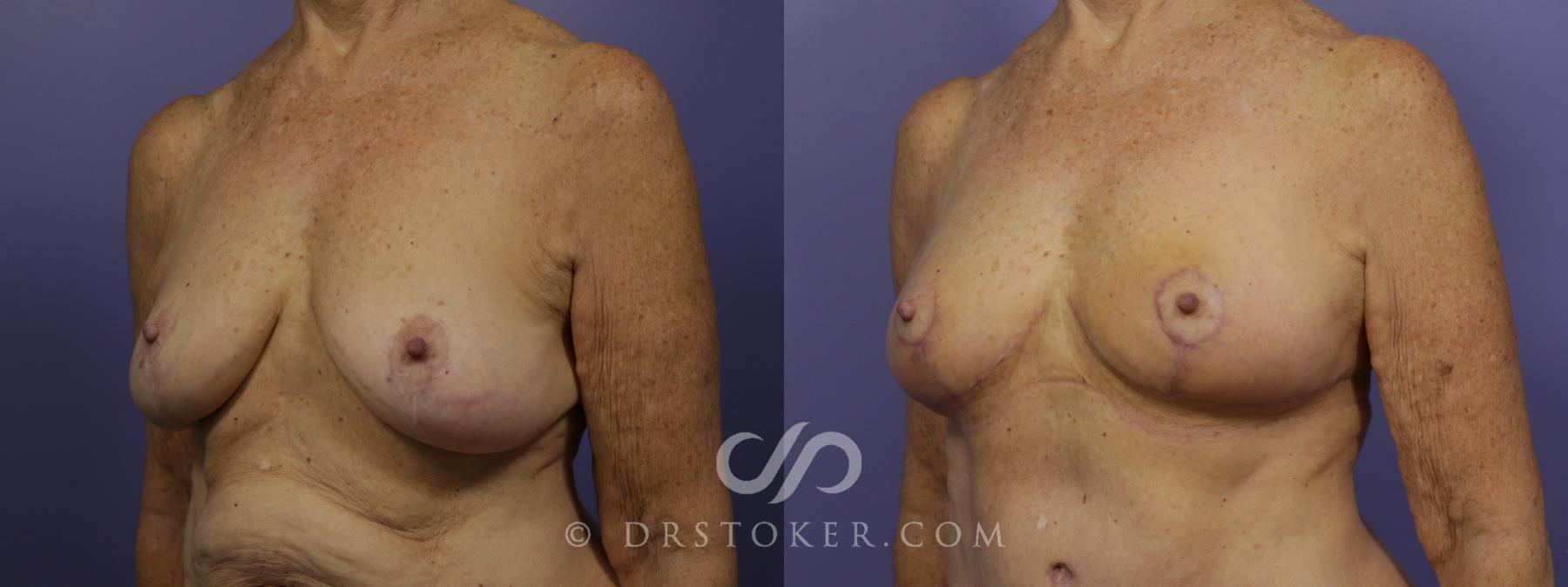 Before & After Breast Reduction (for Women) Case 1290 View #2 View in Los Angeles, CA
