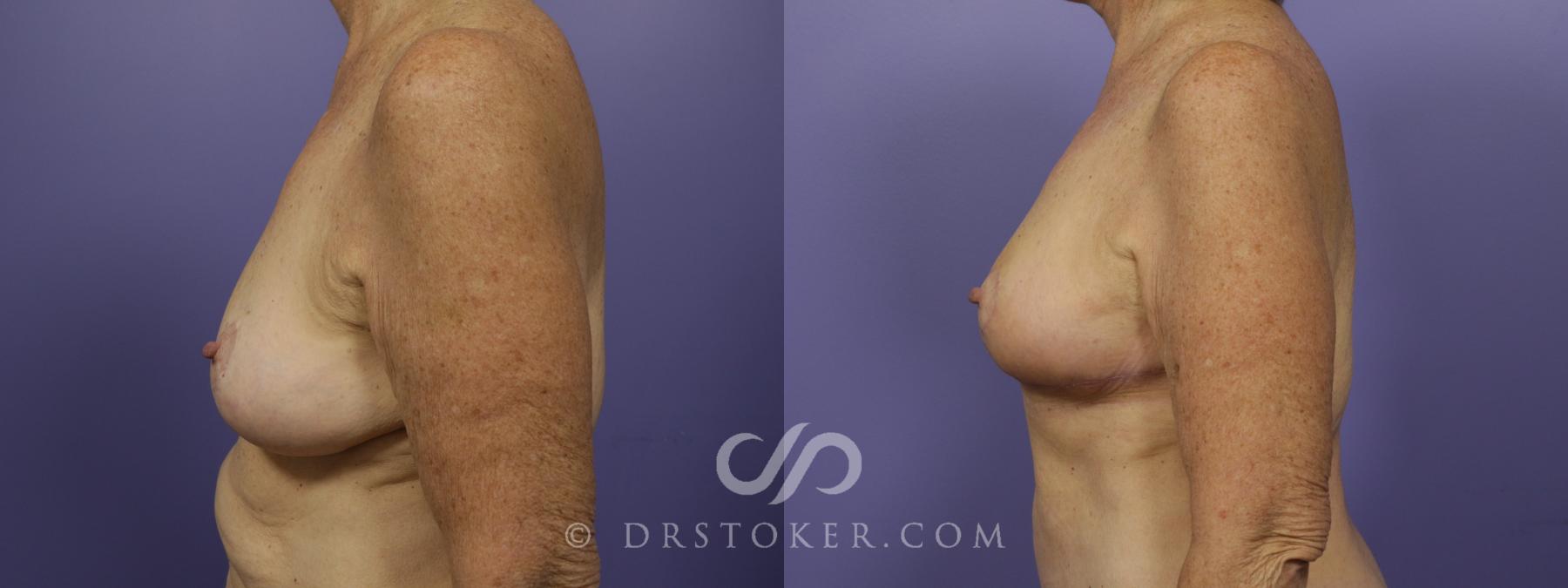 Before & After Breast Reduction (for Women) Case 1290 View #3 View in Los Angeles, CA