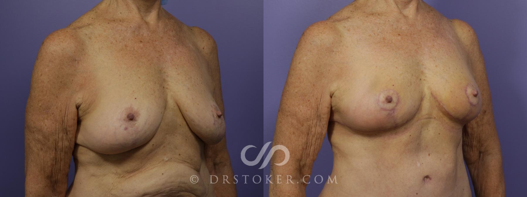 Before & After Breast Reduction (for Women) Case 1290 View #4 View in Los Angeles, CA